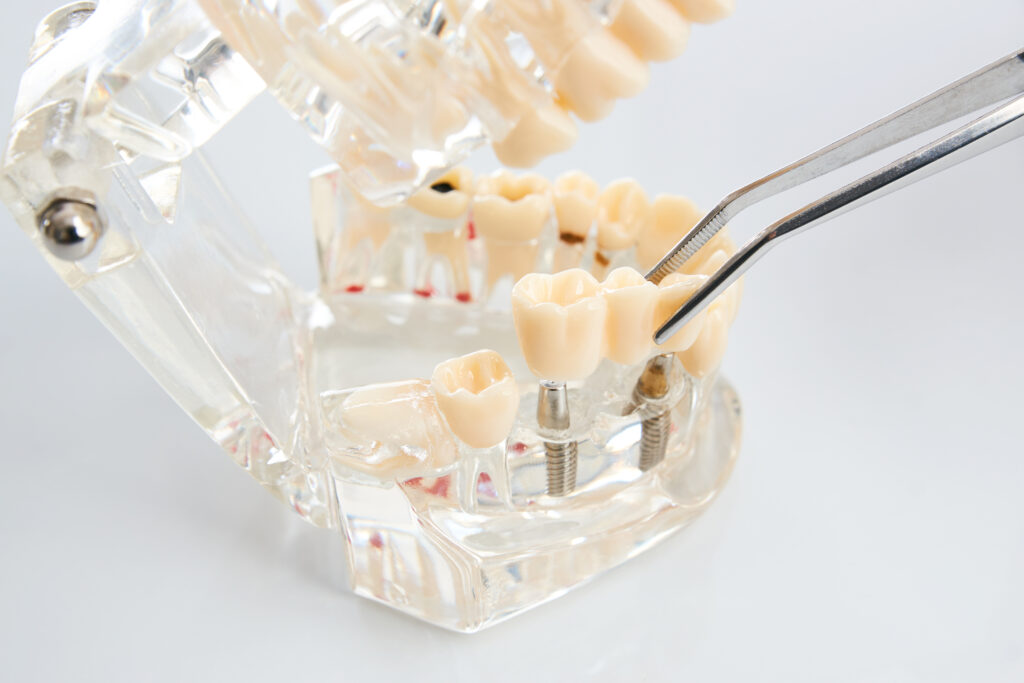 Smiling woman at the dentist's appointment. Positive girl visits the dentist and wants to make her teeth even better Dental technician placing the fixed partial denture, dental bridge on the screw implants, close-up. Dentists tooth model with screw implant for teaching, learning showing teeth and gums